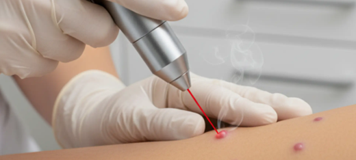Cauterizacion